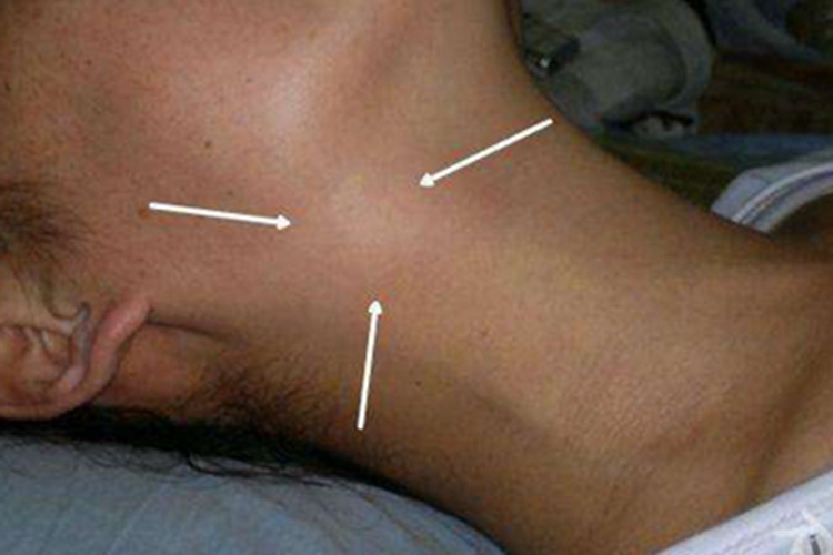 扁桃体炎颈部肿块图