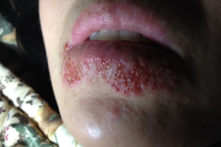 涂口红过敏的症状图片
