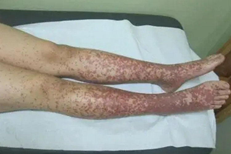 血小板减少性紫癜小腿血点图