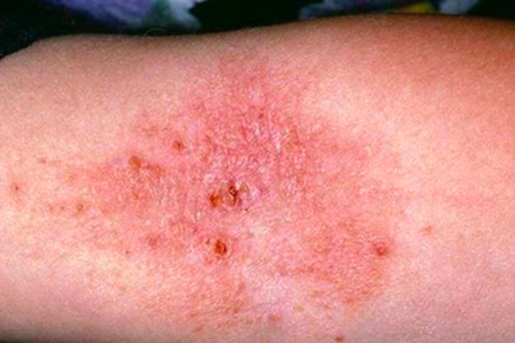 感染性湿疹肘窝发红有痂皮图 感染性湿疹肘窝发红有痂皮图