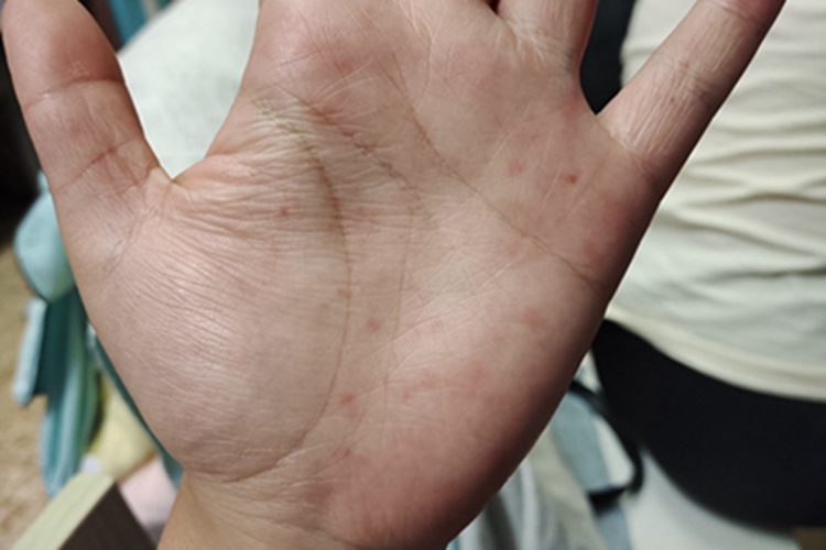 急性湿疹手掌有几个小红点图