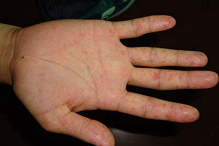 自体敏感性湿疹手部红点图 自体敏感性湿疹手部红点图