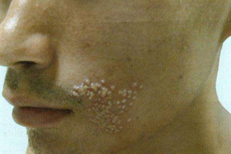 脓疱病口周症状图 脓疱病口周症状图