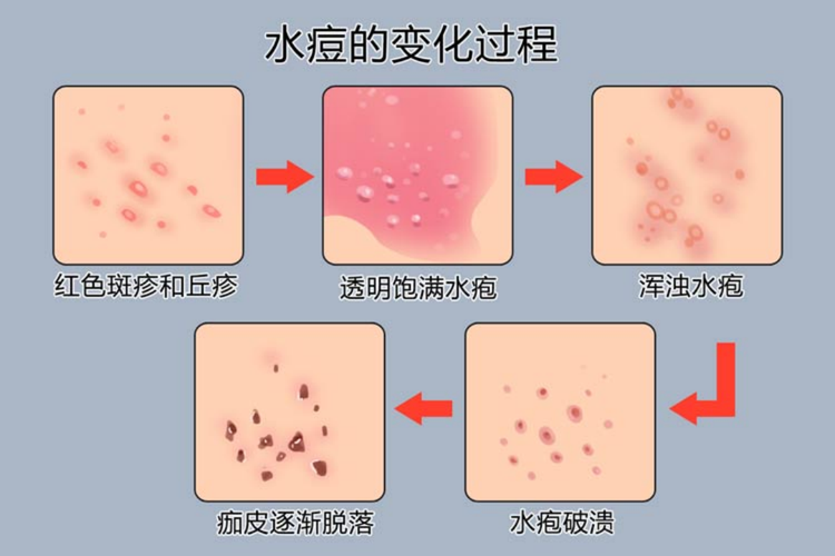 水痘的恢复过程图解图片