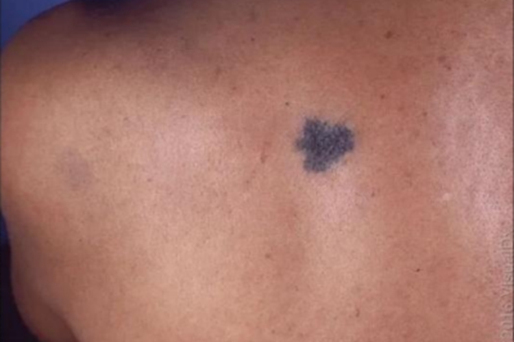 细胞蓝痣背部症状图