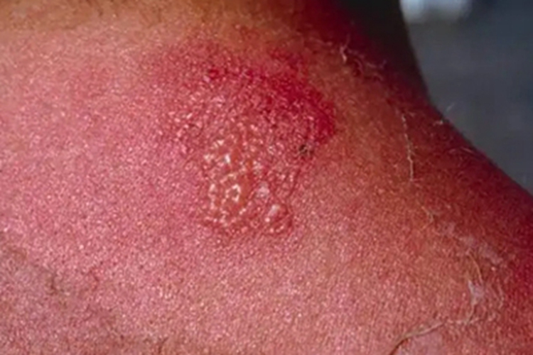 慢性光化性皮炎后颈小水疱图