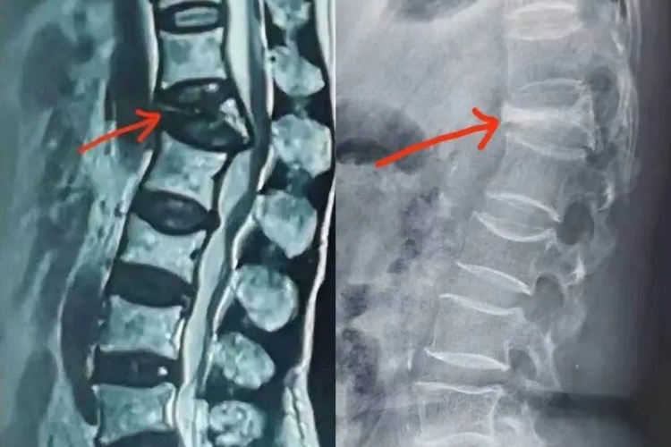 L2椎体骨折位置图