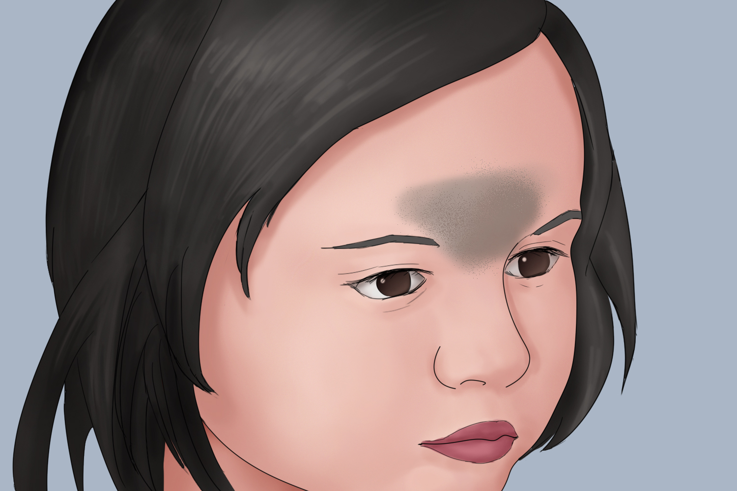 宝宝太田痣眉心发青图