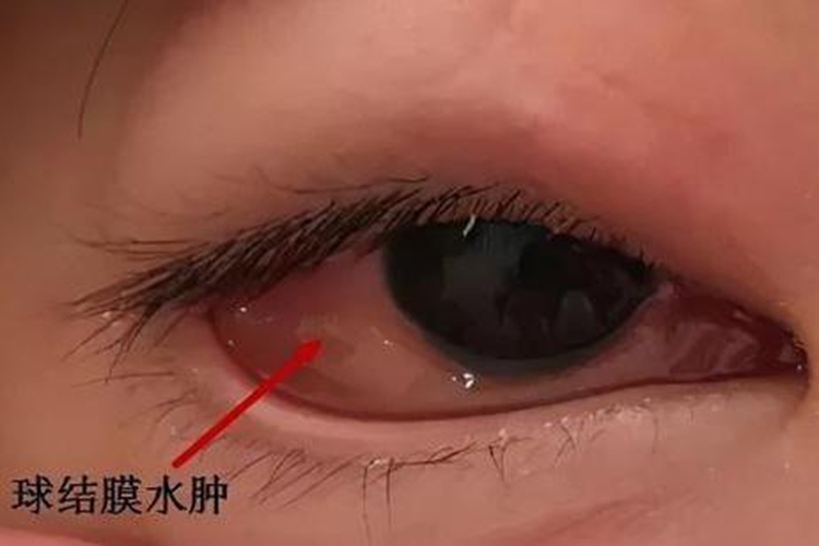 结膜炎眼睛周围一圈发红图