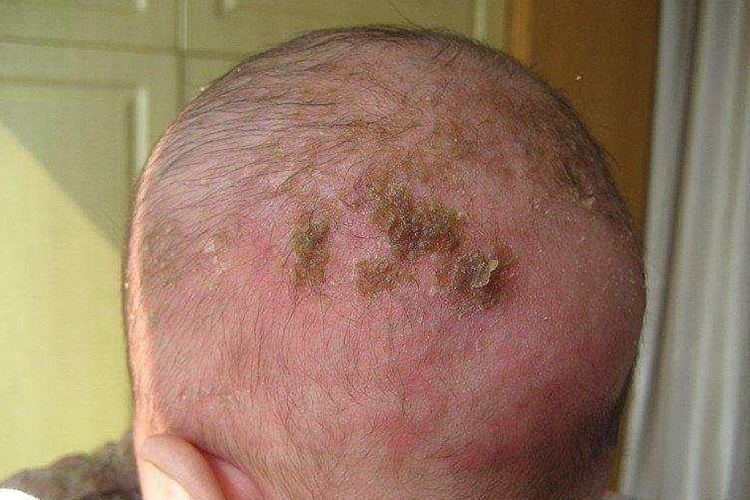 婴儿头上湿疹图 婴儿头上湿疹图