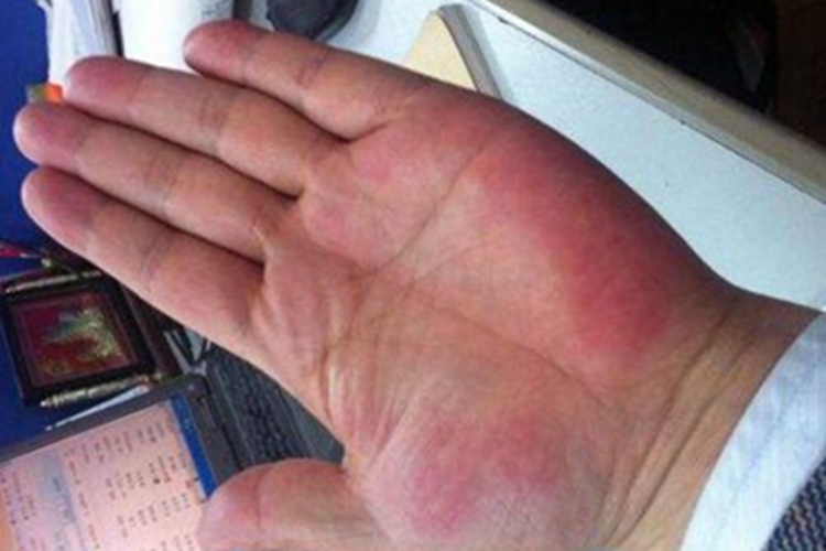 肝硬化手掌发红图 肝硬化手掌发红图