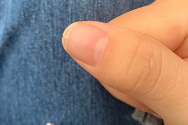 甲纵裂手指甲缺损图 甲纵裂手指甲缺损图