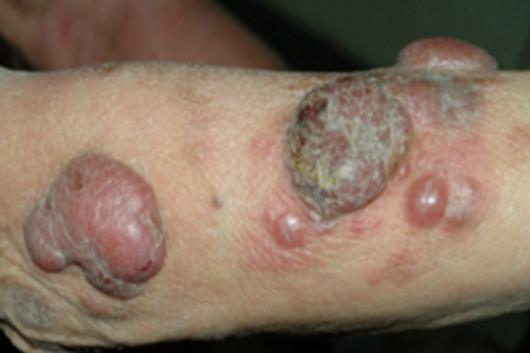 蕈样肉芽肿肿瘤期症状图 蕈样肉芽肿肿瘤期症状图