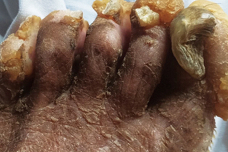 先天性厚甲症脚趾甲变形图 先天性厚甲症脚趾甲变形图