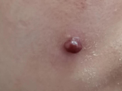化脓性肉芽肿面部有个暗红色的疙瘩图.jpeg