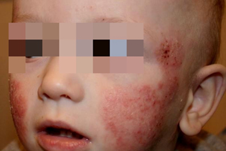 特应性皮炎疙瘩图 特应性皮炎疙瘩图