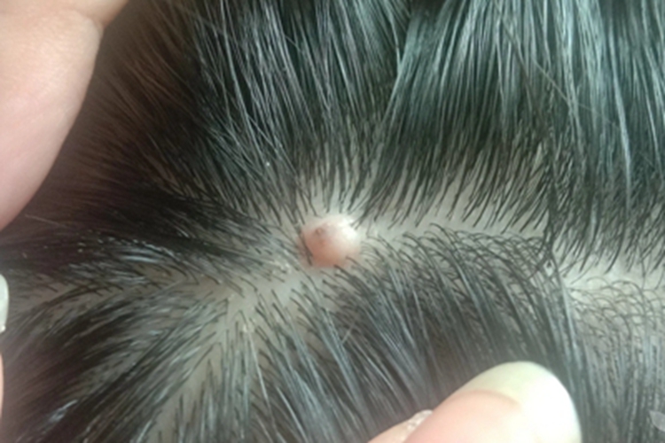 毛囊周围纤维瘤疙瘩图