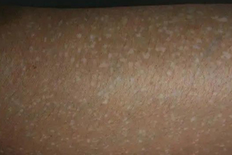 老年性点状白斑小腿白斑图