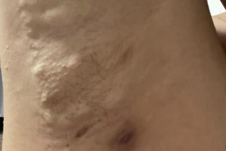 腋下皮脂腺囊肿图