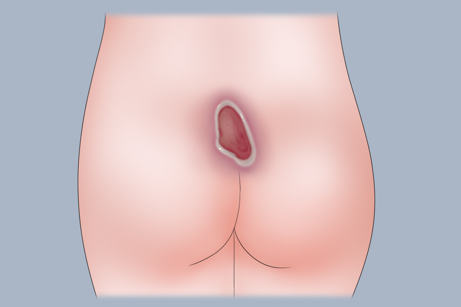 骶尾部二期压疮图