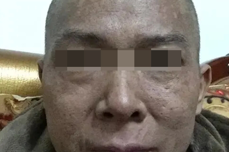 化疗后头面部色素沉着图