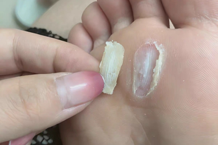 胼胝脚底发黄的硬块掉了图
