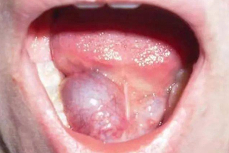 舌下腺囊肿舌头下面长大包图