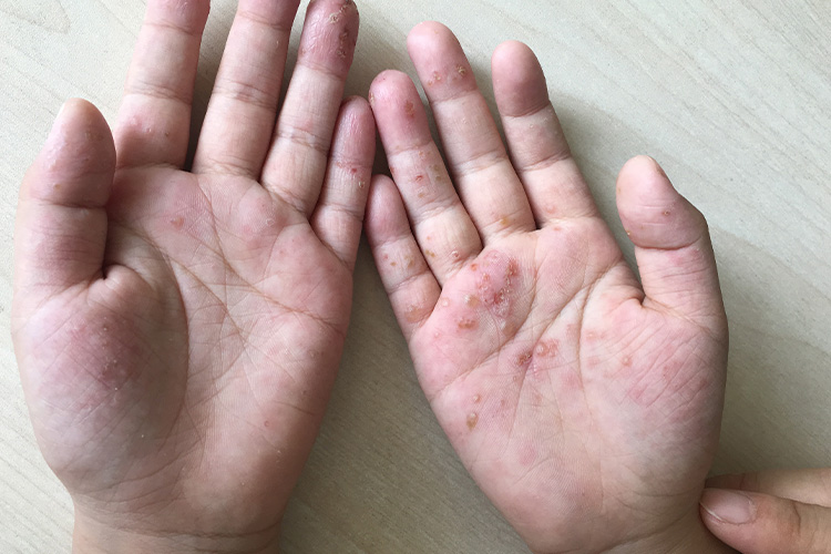 手部汗疱疹