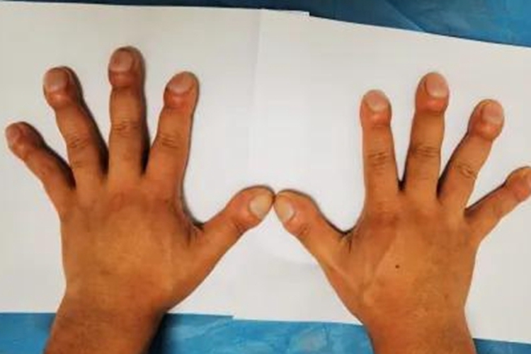 杵状指手指膨大似鼓槌图