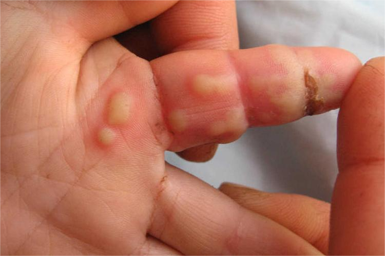 连续性肢端皮炎化脓图 连续性肢端皮炎化脓图