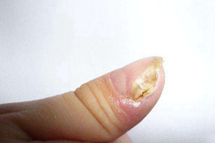 慢性甲沟炎手指甲周边红肿图