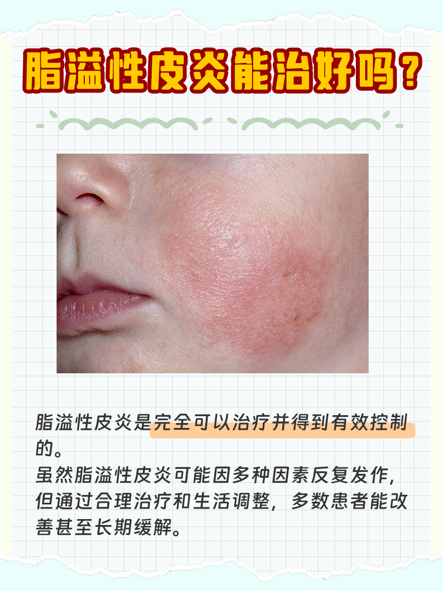 脂溢性皮炎真的能治好吗？一文解读