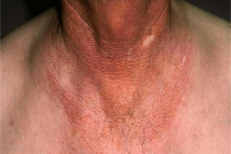 西瓦特皮肤异色病症状图