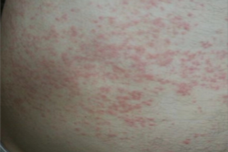 慢性湿疹右腹小红疙瘩图