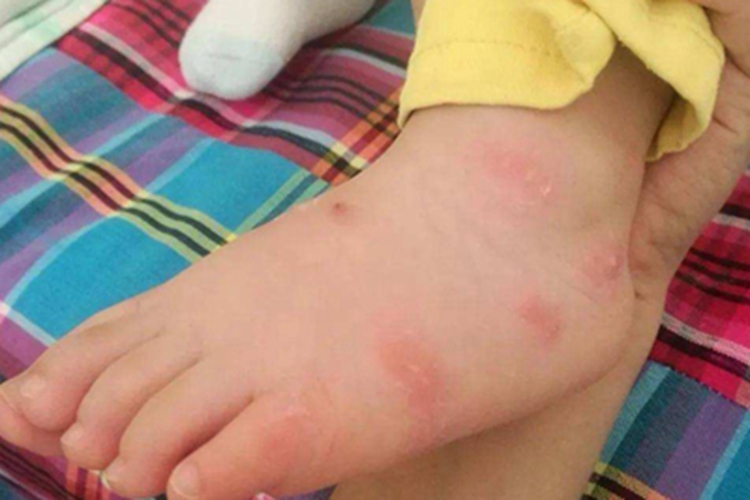 体虱病脚背上红色斑片图