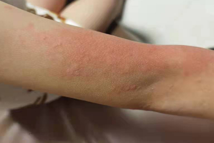 荨麻疹风团图片