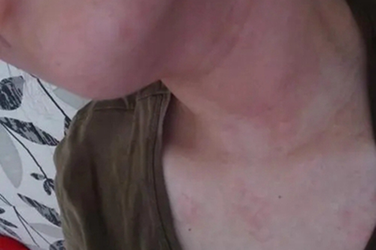 芒果皮炎颈部症状图