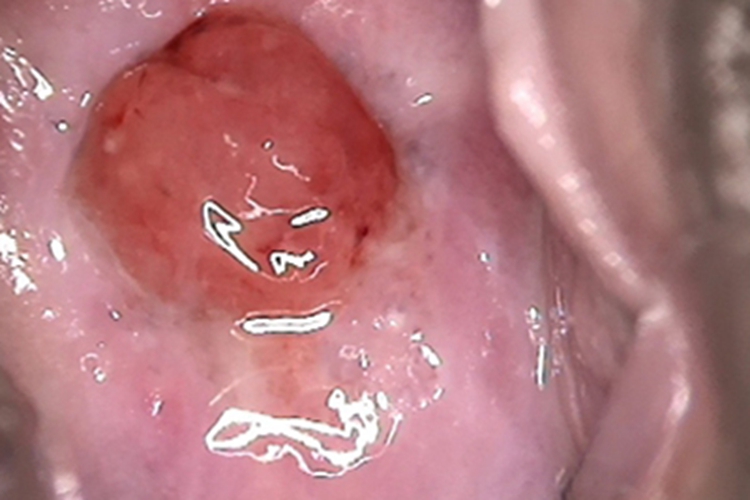 宫颈息肉症状图