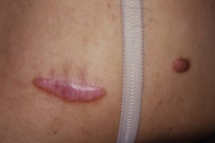 增生性瘢痕背部有隆起瘢痕图