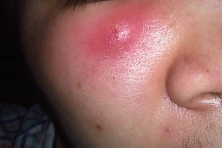 疖脸上长结节图