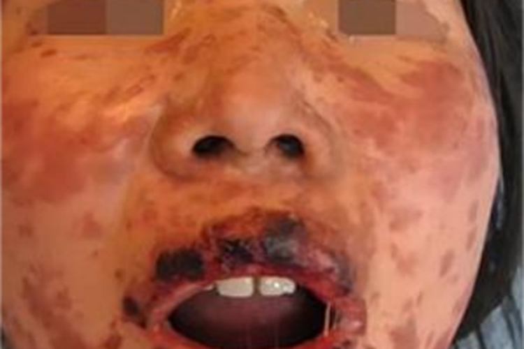 重症多形红斑红斑图 重症多形红斑红斑图