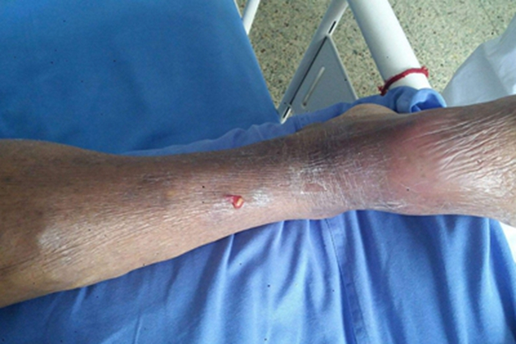 血栓闭塞性脉管炎小腿皮肤发黑图 血栓闭塞性脉管炎小腿皮肤发黑图