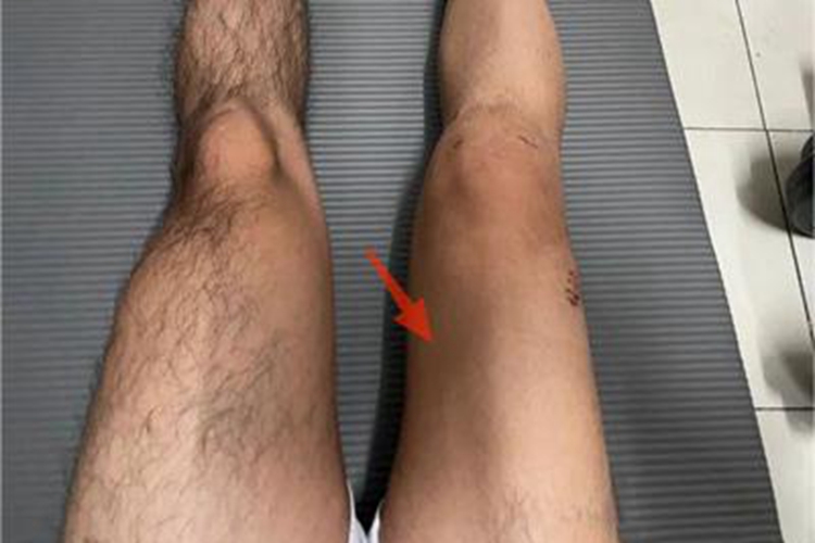 肌肉萎缩大腿症状图 肌肉萎缩大腿症状图