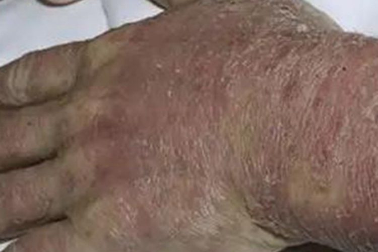 冬季瘙痒症手背红肿起皮图