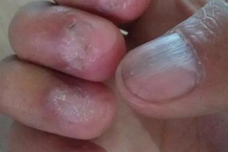 慢性铊中毒手指甲萎缩图