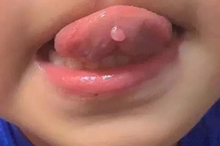 潴留性黏液囊肿软包图