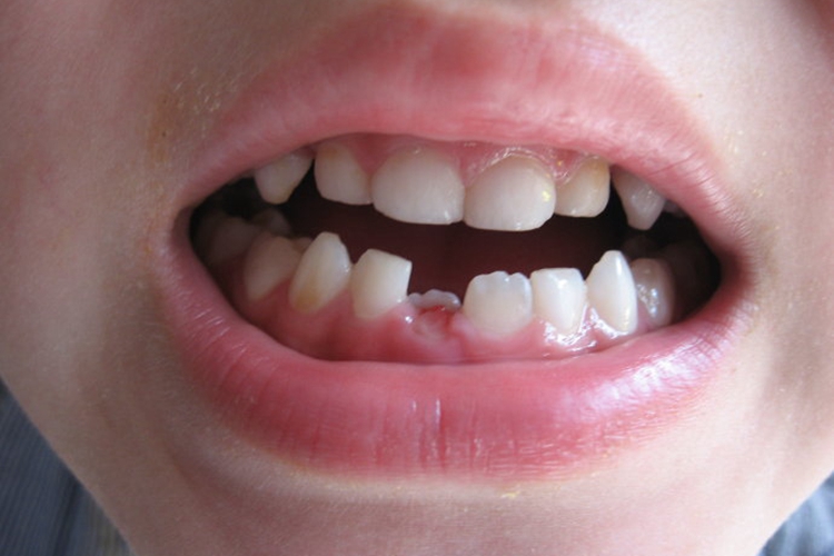 小孩牙齿横着长的图片图片