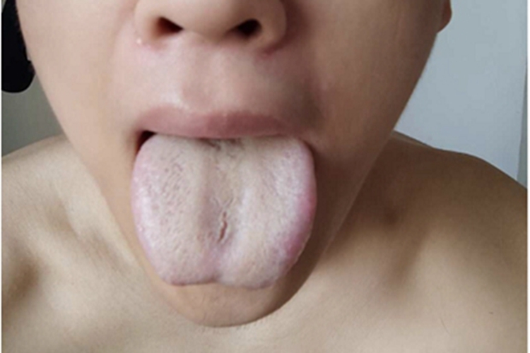 毛舌舌头毛绒绒发白图 毛舌舌头毛绒绒发白图