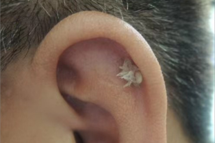 疣耳部肉球图 疣耳部肉球图