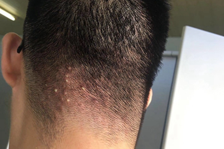 项部瘢痕疙瘩性毛囊炎头皮丘疹图 项部瘢痕疙瘩性毛囊炎头皮丘疹图